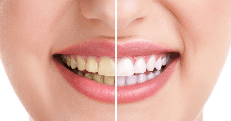 Prevent Future Stains on Tooth Enamel by Identifying the Source of Stained Teeth