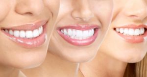 Three female smiles with teeth