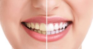 What are the causes of your stained teeth?